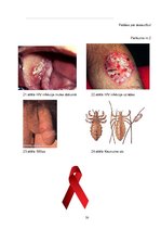 Referāts 'Seksuāli transmisīvās slimības un to izplatība Latvijā', 30.