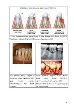 Diplomdarbs 'Periodonta slimību diagnostika un ārstēšanas metodes', 32.