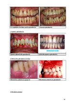 Diplomdarbs 'Periodonta slimību diagnostika un ārstēšanas metodes', 64.