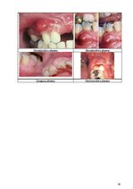 Diplomdarbs 'Periodonta slimību diagnostika un ārstēšanas metodes', 65.