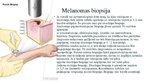 Prezentācija 'Melanomas biopsija, pataloģija', 9.