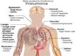 Prezentācija 'Akūta pulmonoloģija', 29.