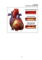 Referāts 'Miokarda infarkta attīstības riska faktori', 43.