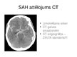 Prezentācija 'Akūti galvas smadzeņu asinsrites traucējumi', 19.