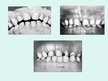 Prezentācija 'Zobu šķilšanās kārtība, likums un patoloģiskas izmaiņas', 17.