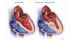 Prezentācija 'Hypertrophic Cardiomyopathy', 4.