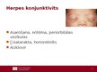 Prezentācija 'Lokālas infekcijas neonatālā periodā', 12.